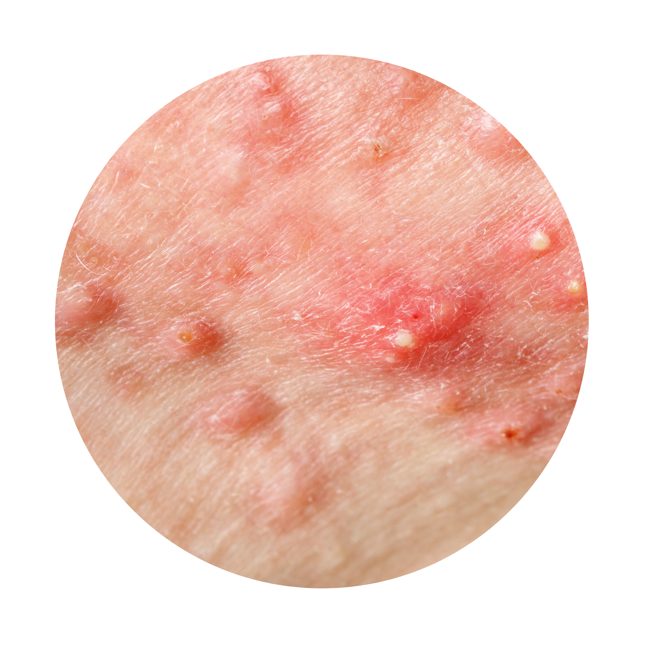 Dermavers Clinic Treatment ACNE & SCAR