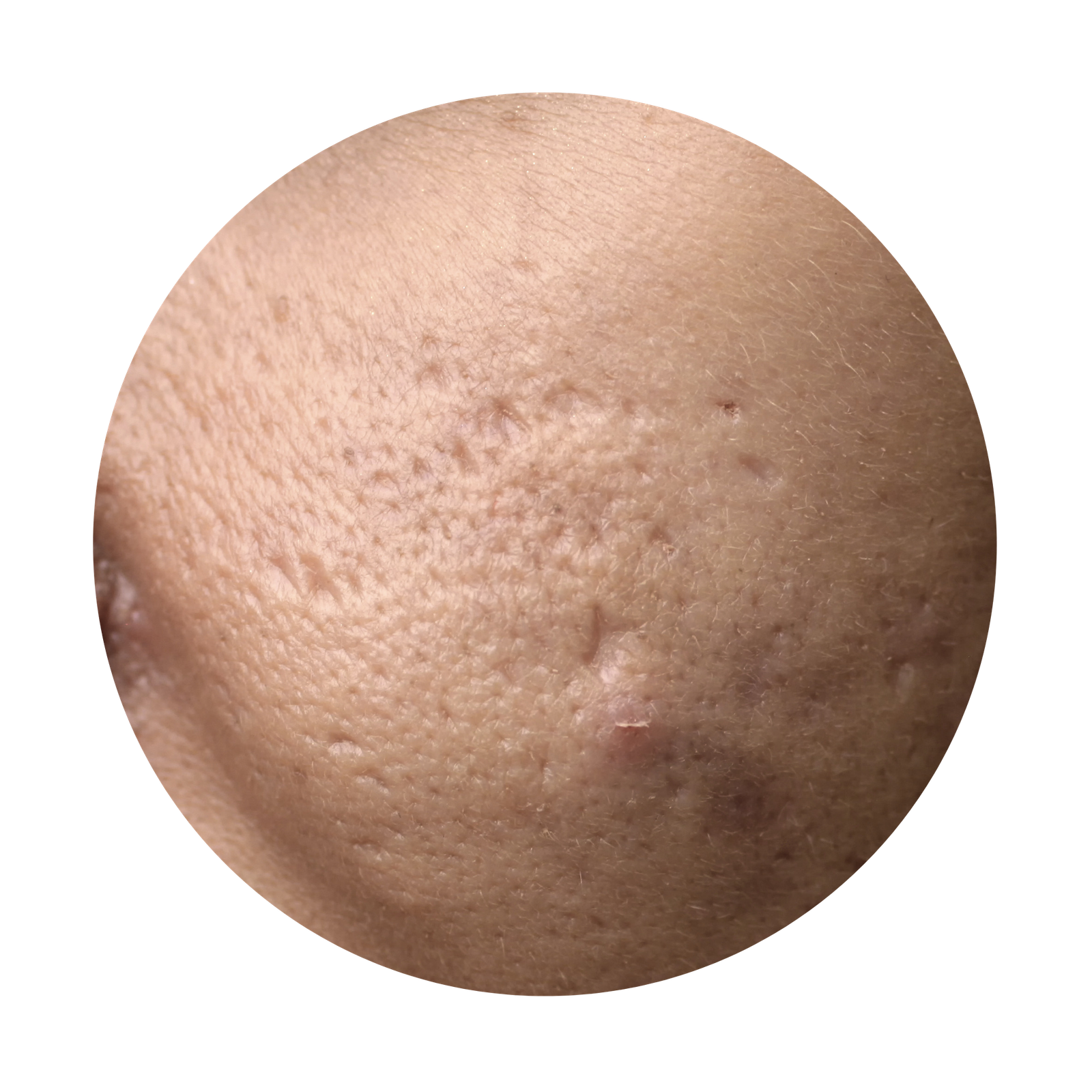 SUBCISION THERAPY
