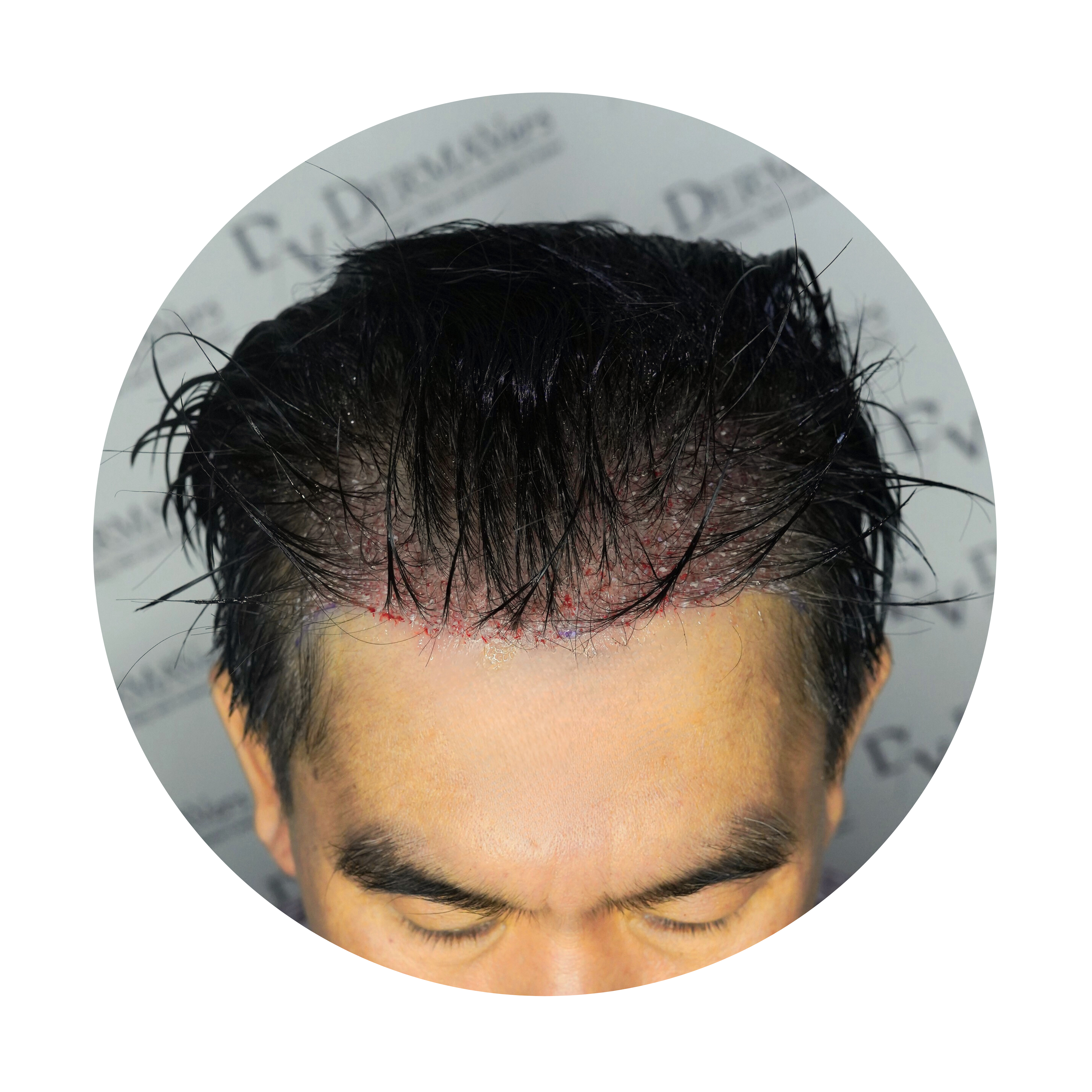 UNSHAVEN HAIR TRANSPLANT